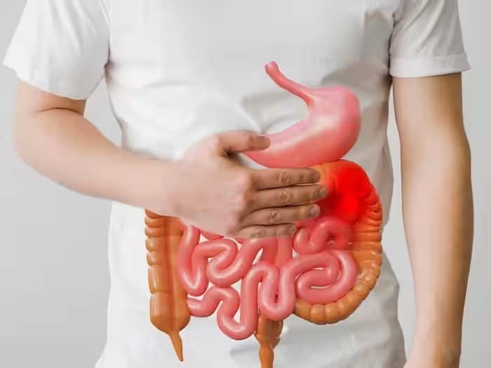 Understanding the Rise of Colon Cancer in Younger People